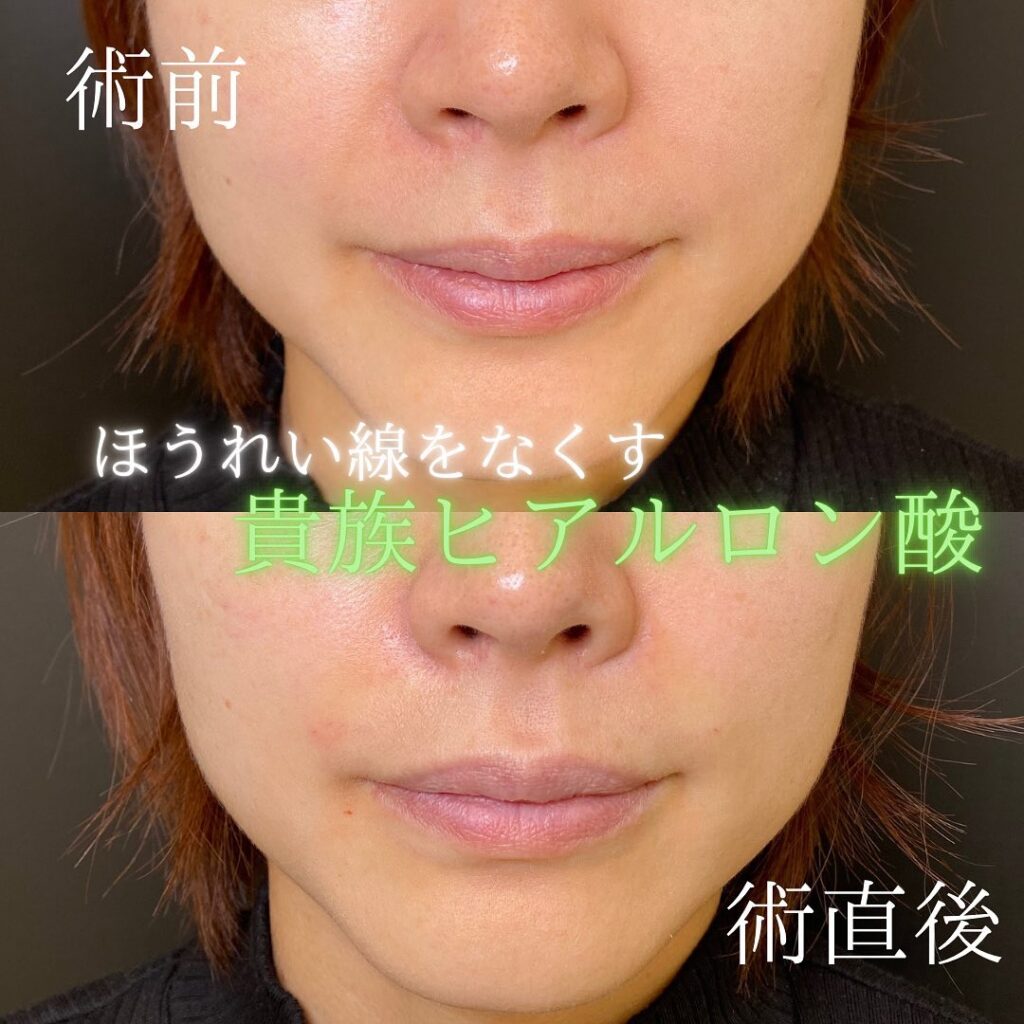 貴族ヒアルで理想の口元を手に入れた女性