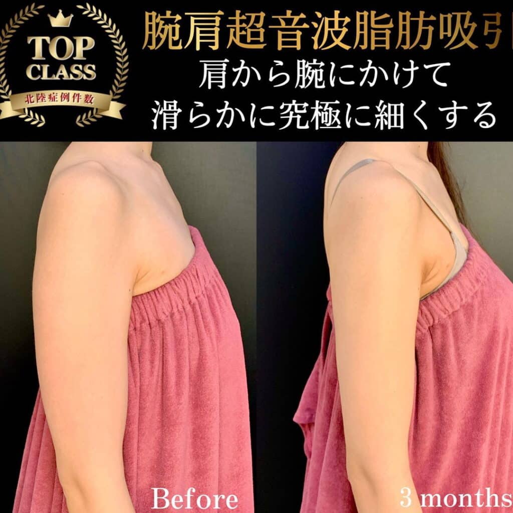 eclinic広島院の腕脂肪吸引の症例写真