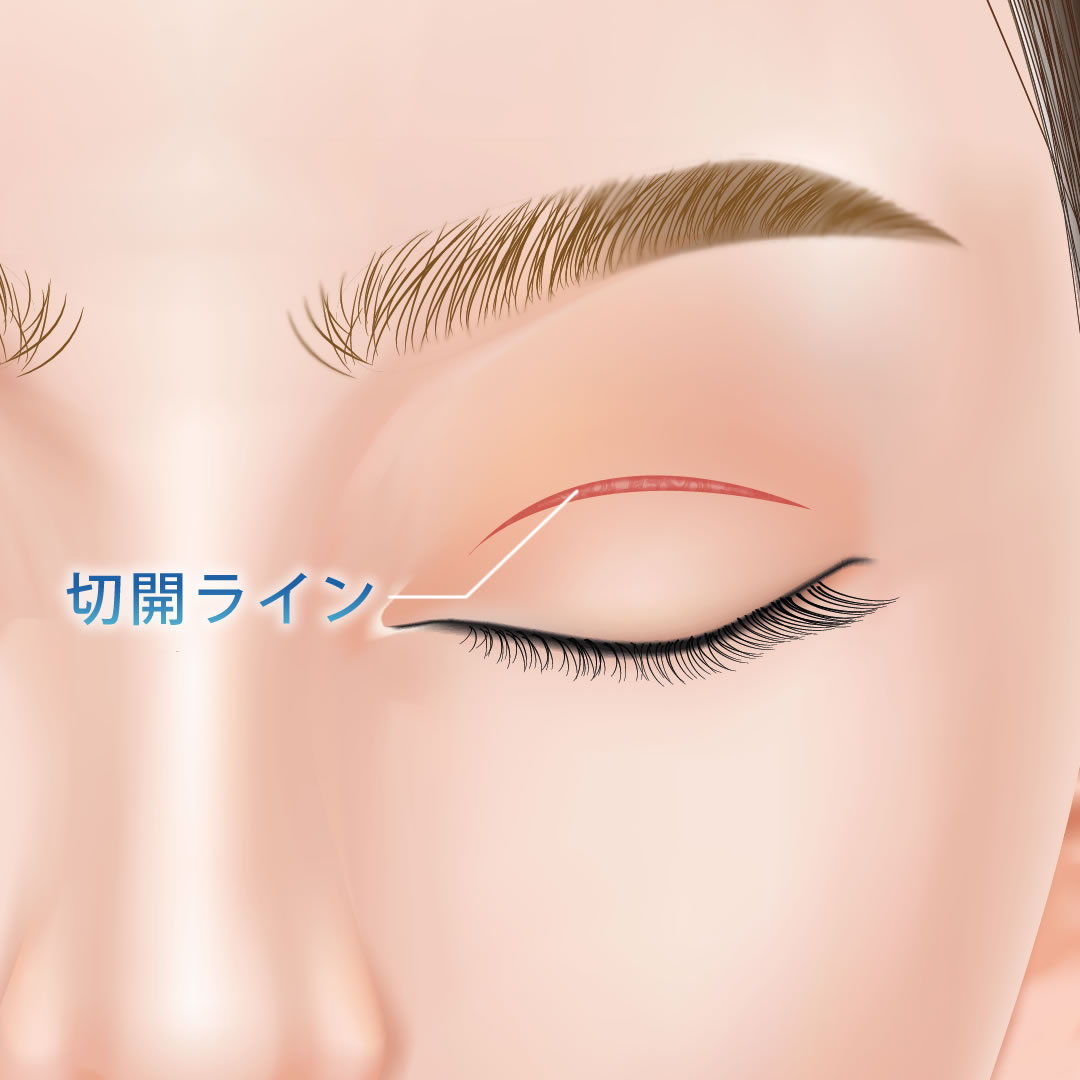 切開