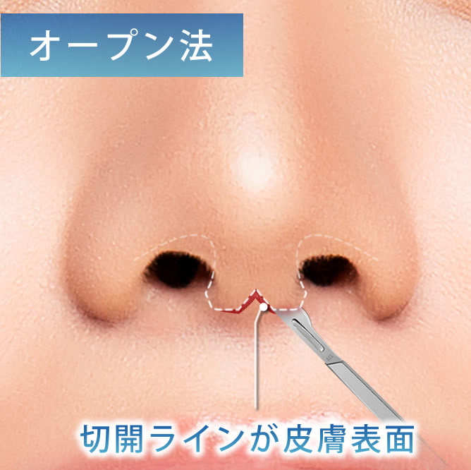 クローズド法の切開ラインの分かり易い図解