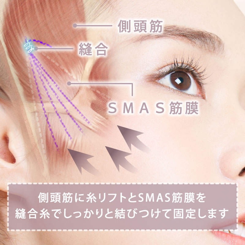 ハイブリッドフェイスリフトの図解