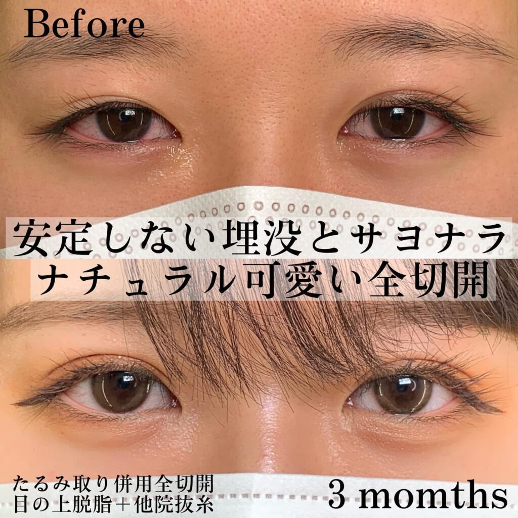 たるみ取り全切開、脱脂、他院抜糸