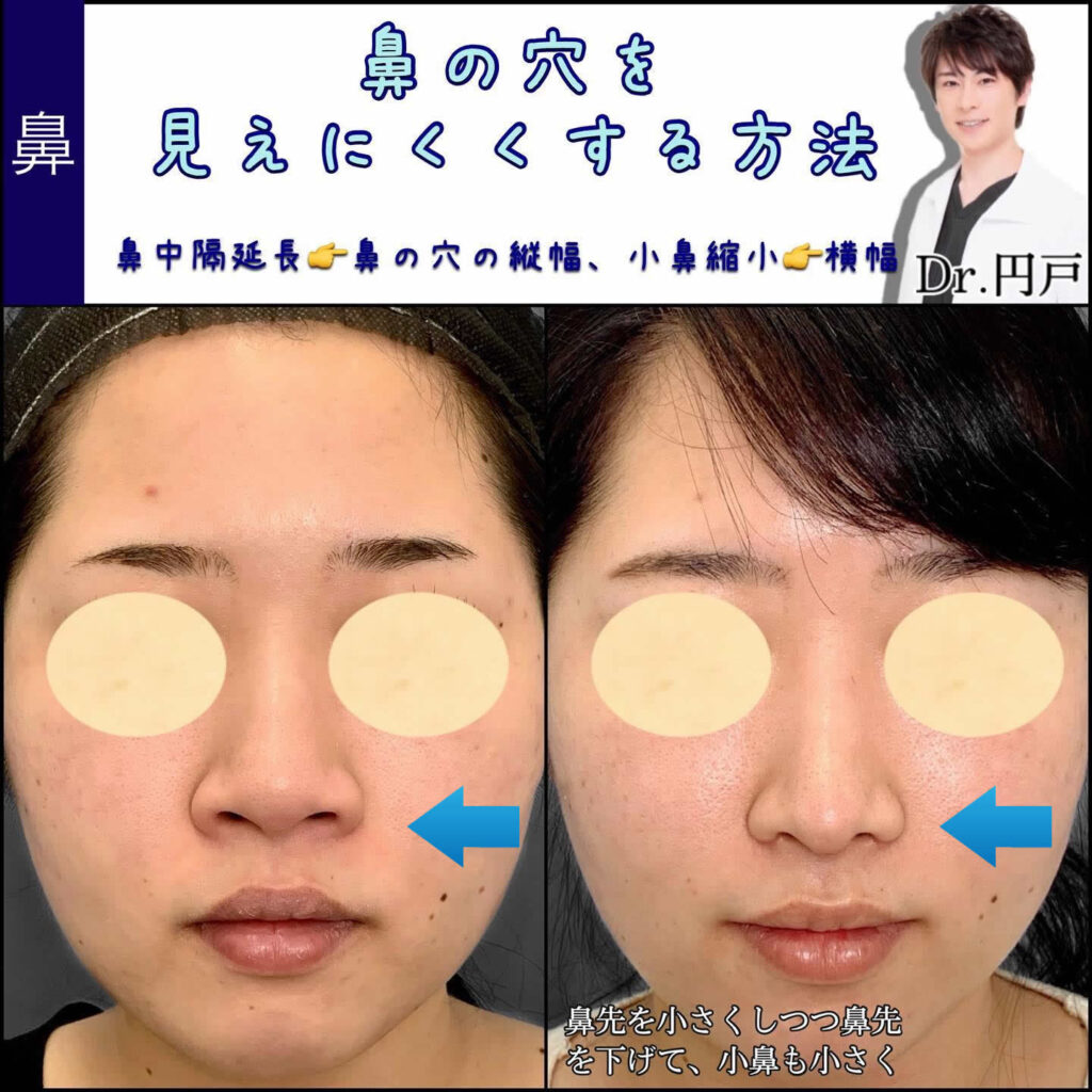 小鼻縮小と鼻中隔延長を同時に行った症例