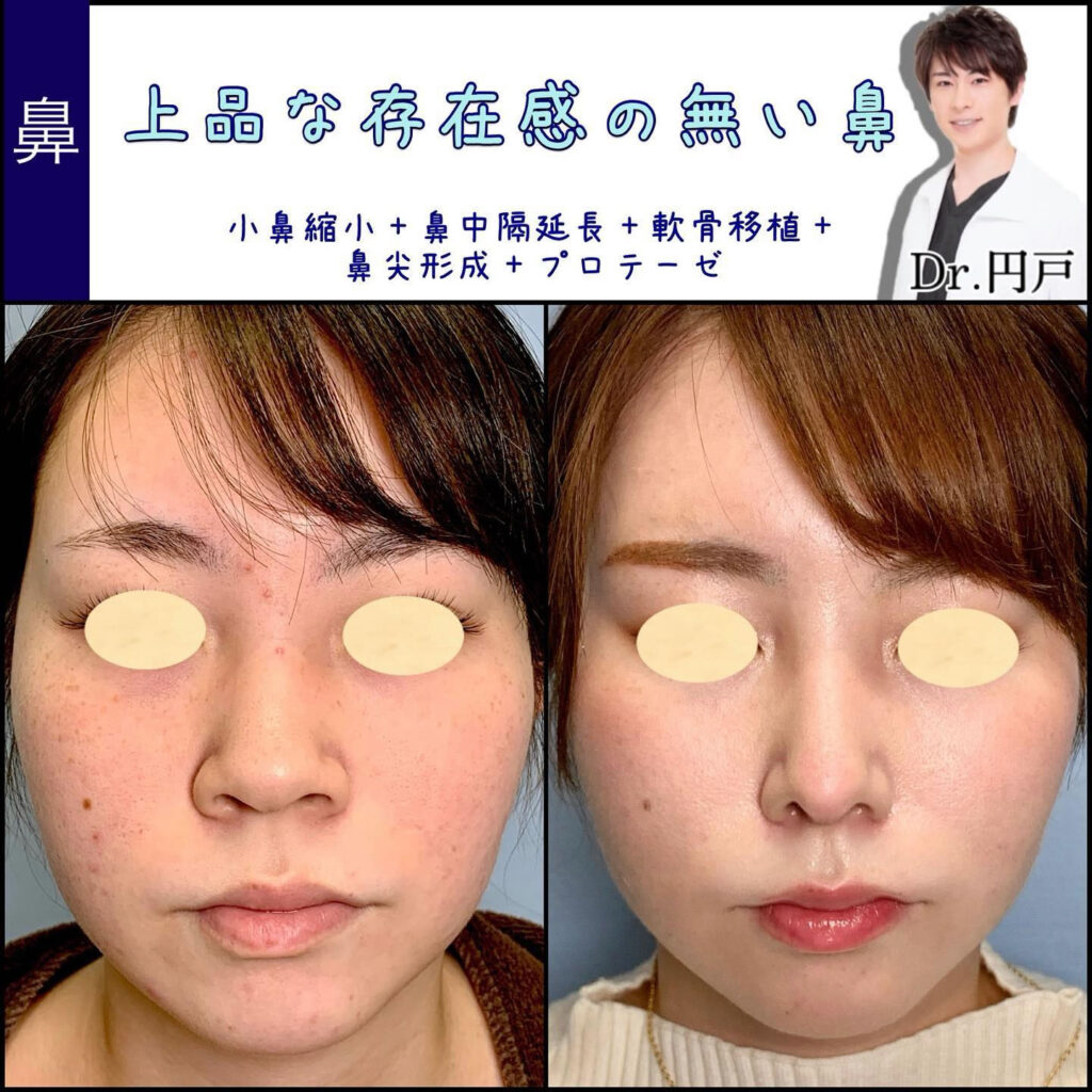 鼻尖形成、軟骨移植、鼻中隔延長、小鼻縮小、プロテーゼを同時に行った正面から見た症例