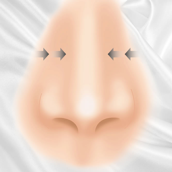 鼻骨骨切りのイメージ