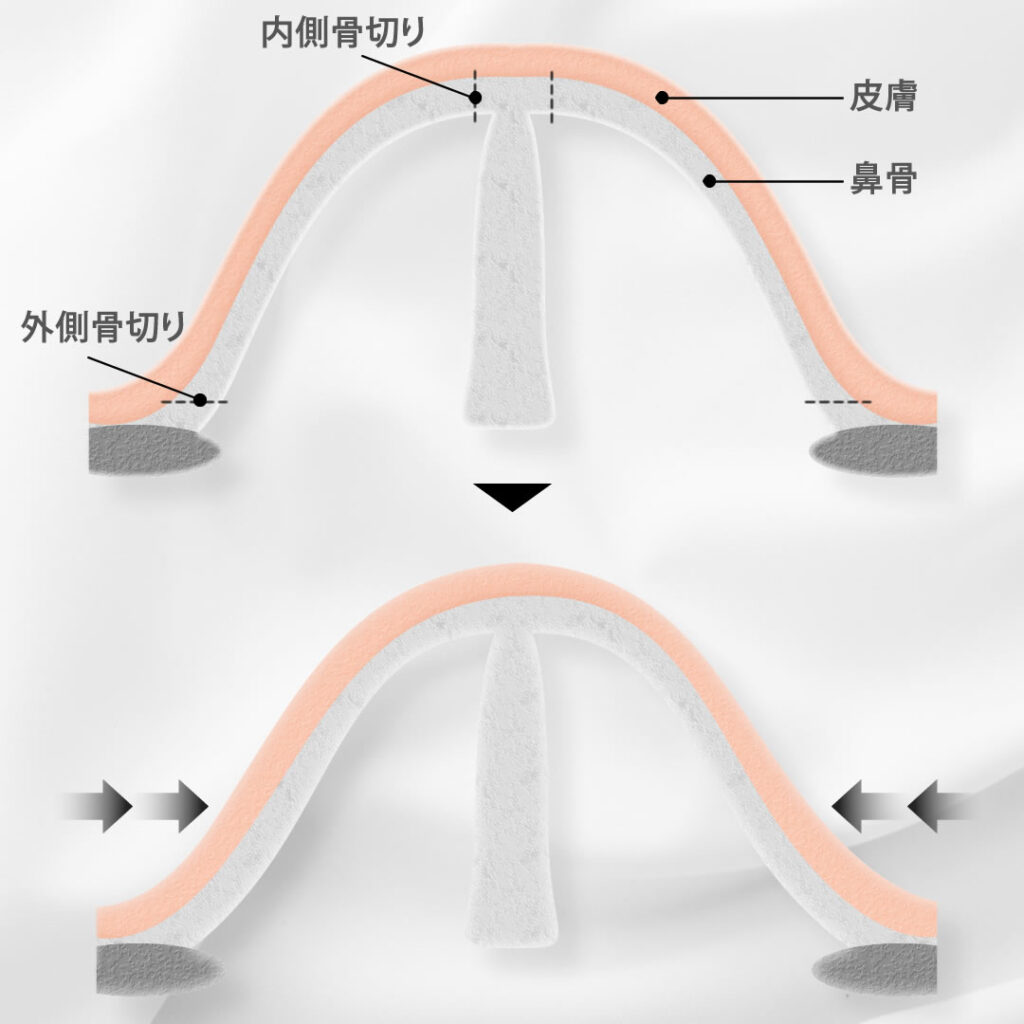鼻骨骨切りの画像