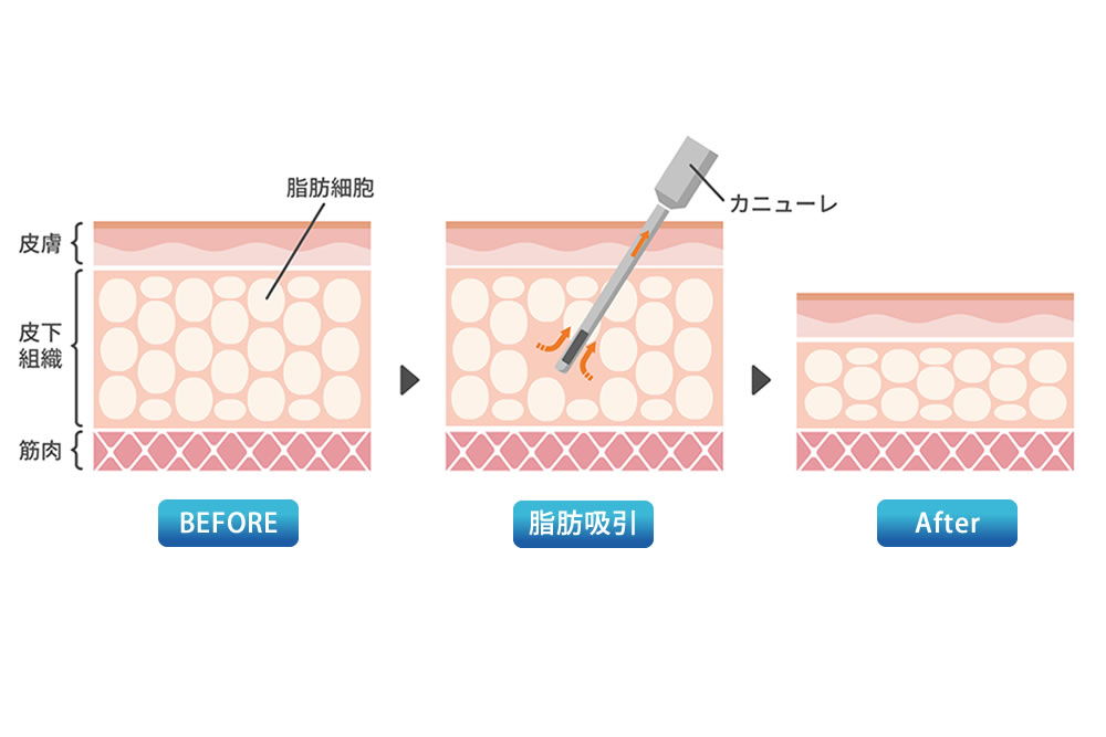 脂肪吸引の図解