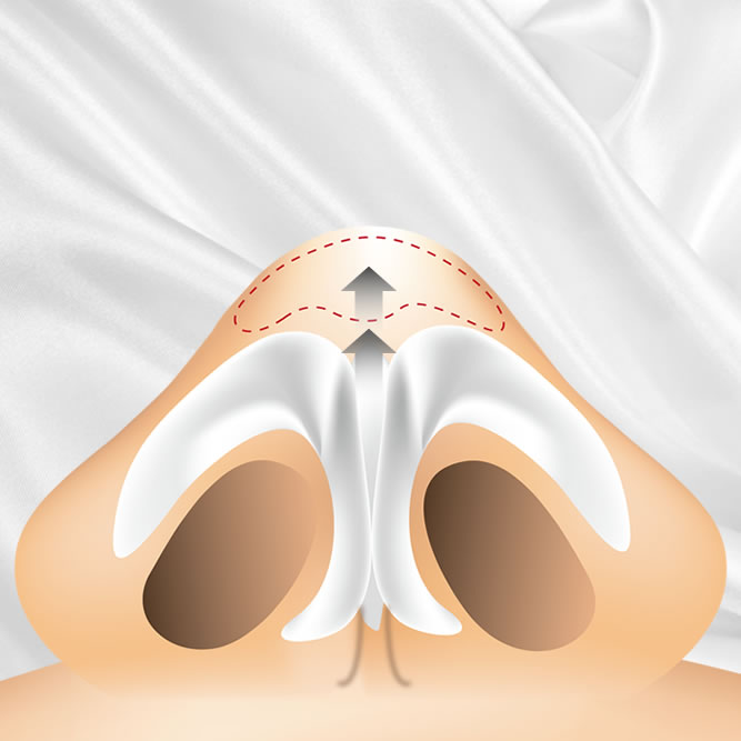 鼻尖形成のイメージ