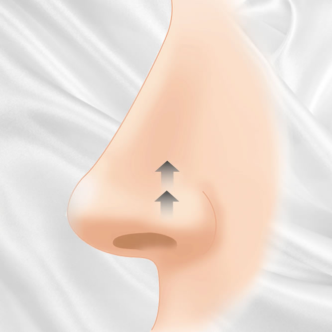 鼻孔縁挙上のイメージ