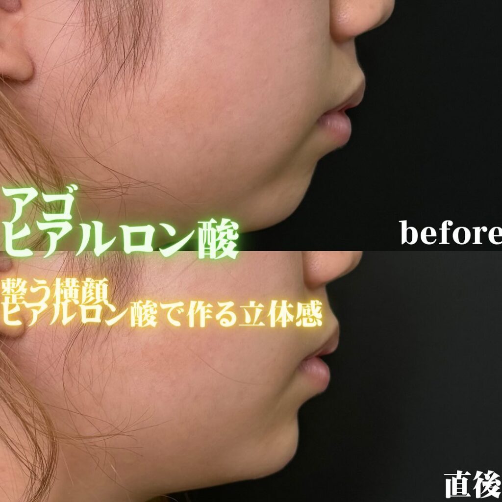 顎のヒアルロン酸の症例写真