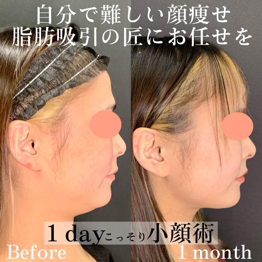eクリニック広島院の小顔脂肪吸引の症例写真