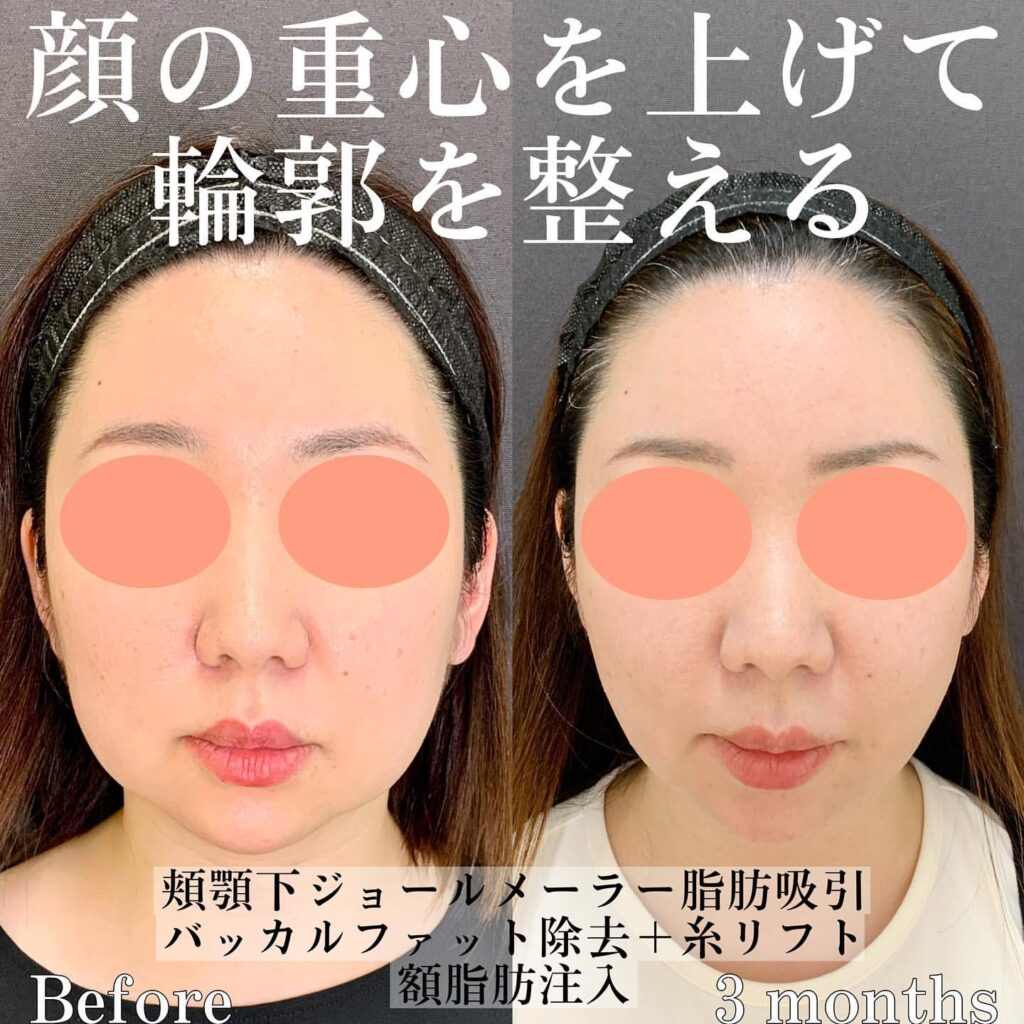 eクリニック広島院の顎下の脂肪吸引とバッカルファット除去と糸リフトと脂肪注入の症例写真