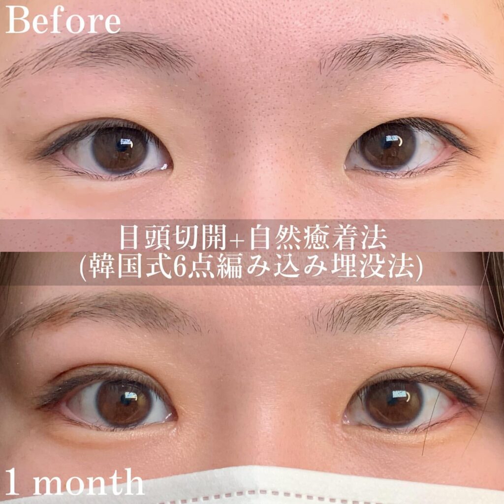 目頭切開と自然癒着法の症例写真