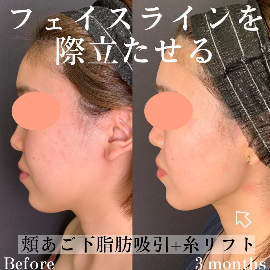 eクリニック広島院の顎下の脂肪吸引と糸リフトの症例写真