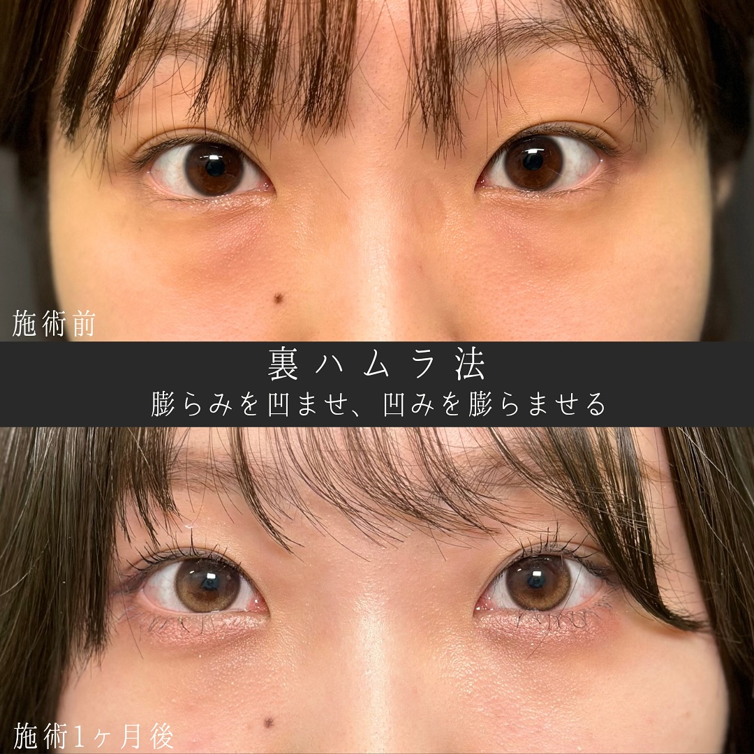 裏ハムラ法の症例写真 (2)