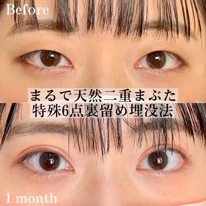 埋没法の症例写真 (5)