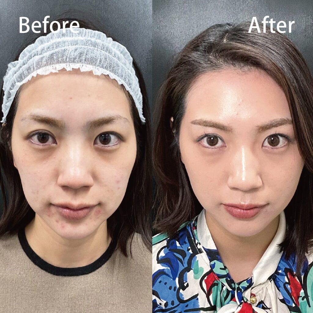 糸リフトの施術前と1か月後の経過の症例写真