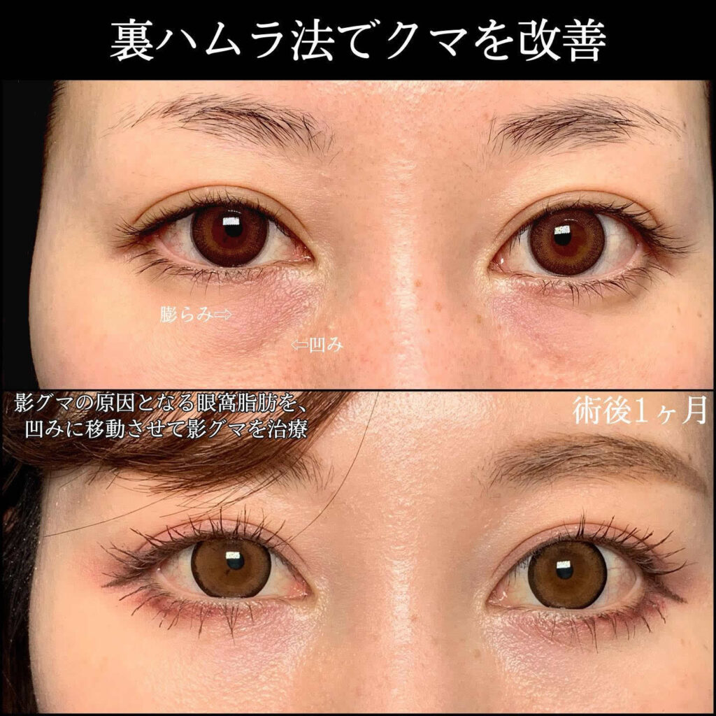 裏ハムラ法でクマを改善した症例