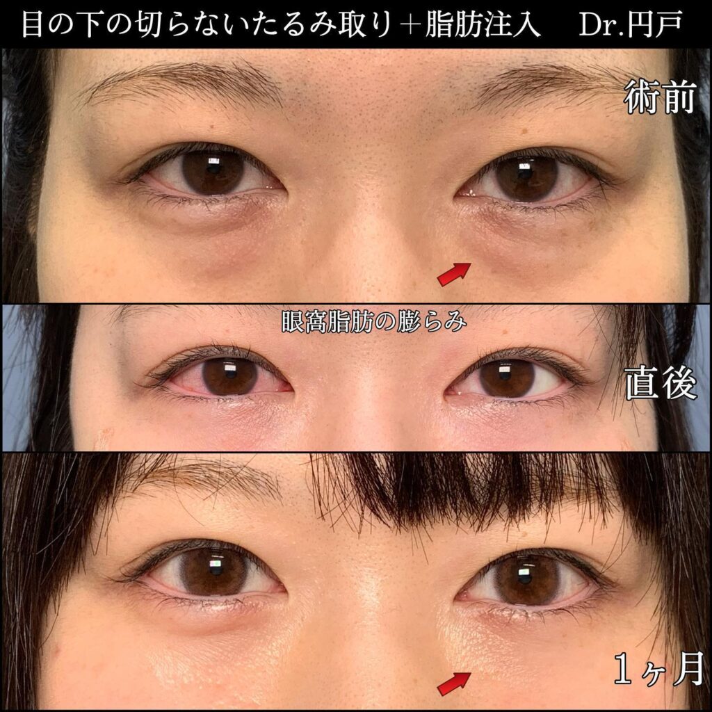 裏ハムラと脂肪注入の1か月後の症例写真-