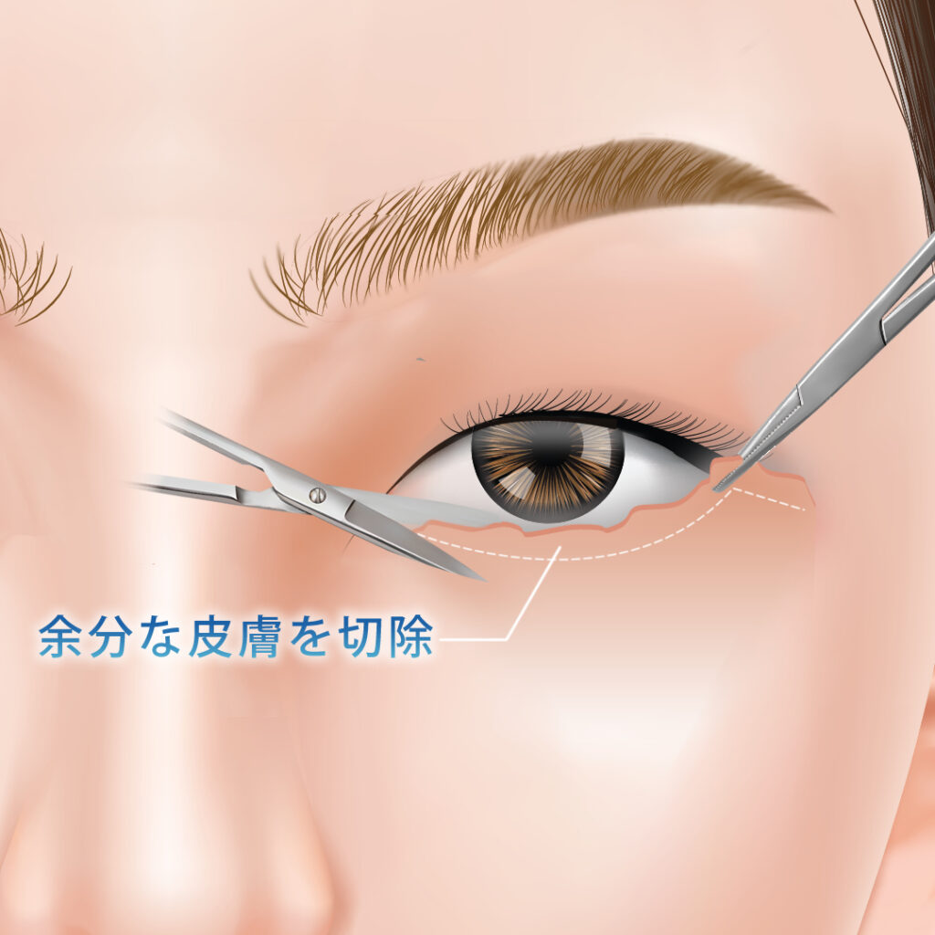 余分な皮膚を切除している図解