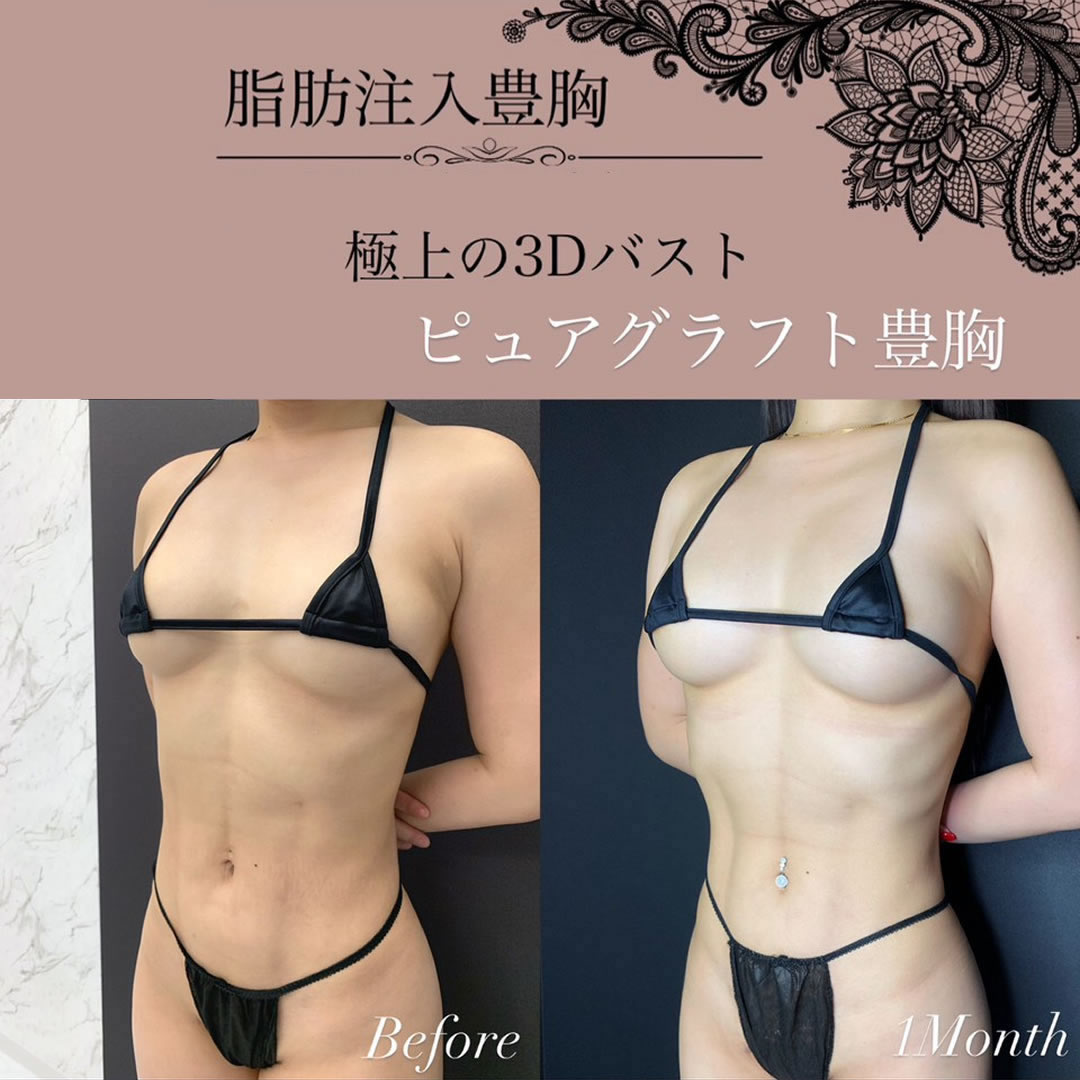 ピュアグラフトを受けた女性の症例写真