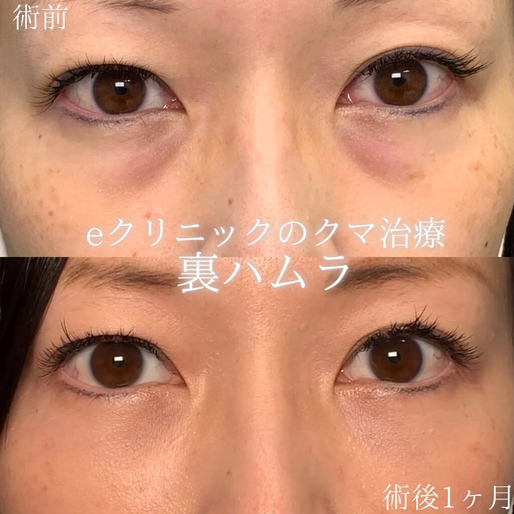 eクリニック広島院の裏ハムラ症例画像(3)