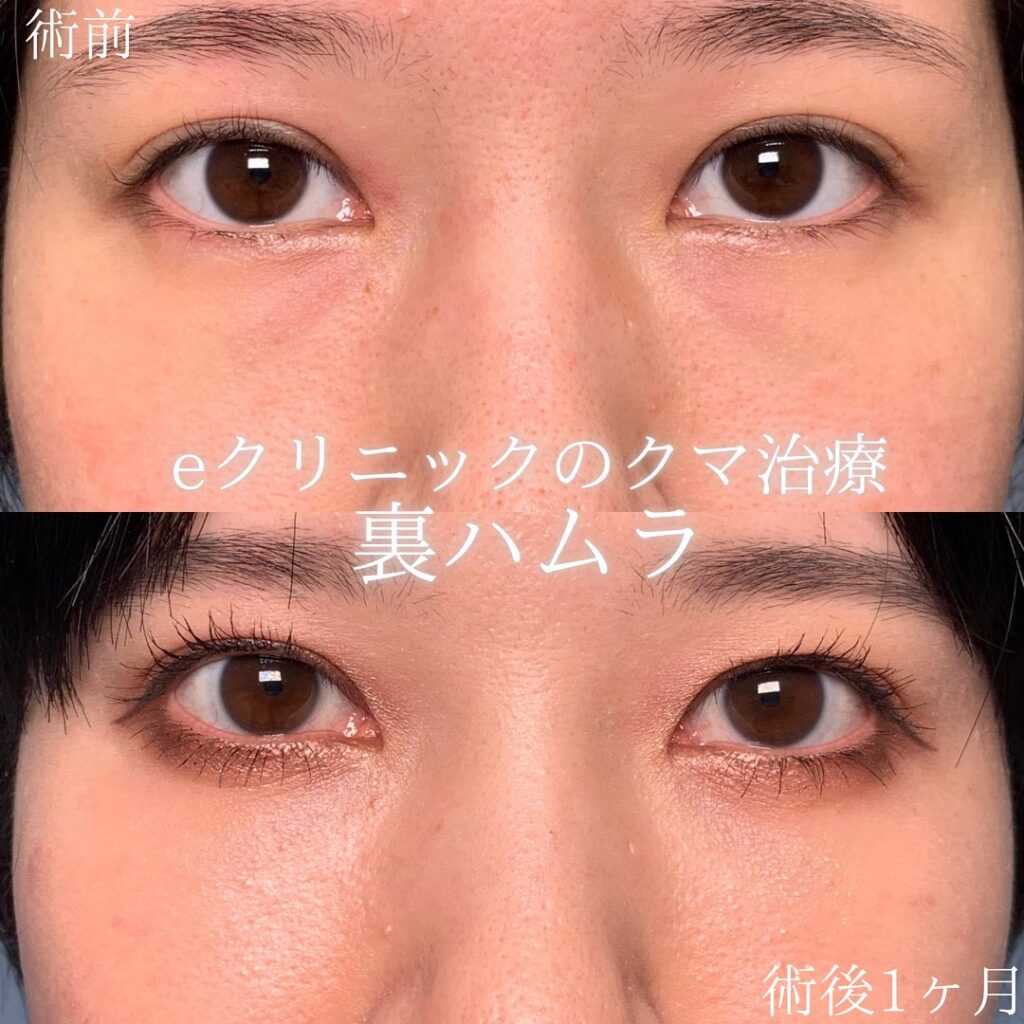 eクリニック広島院の裏ハムラ症例画像(2)