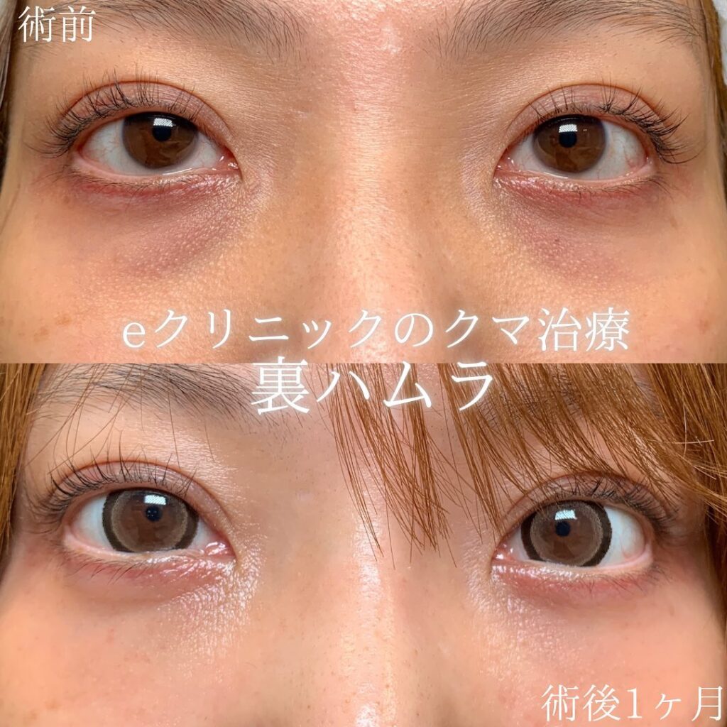 eクリニック広島院の裏ハムラ症例画像(1)