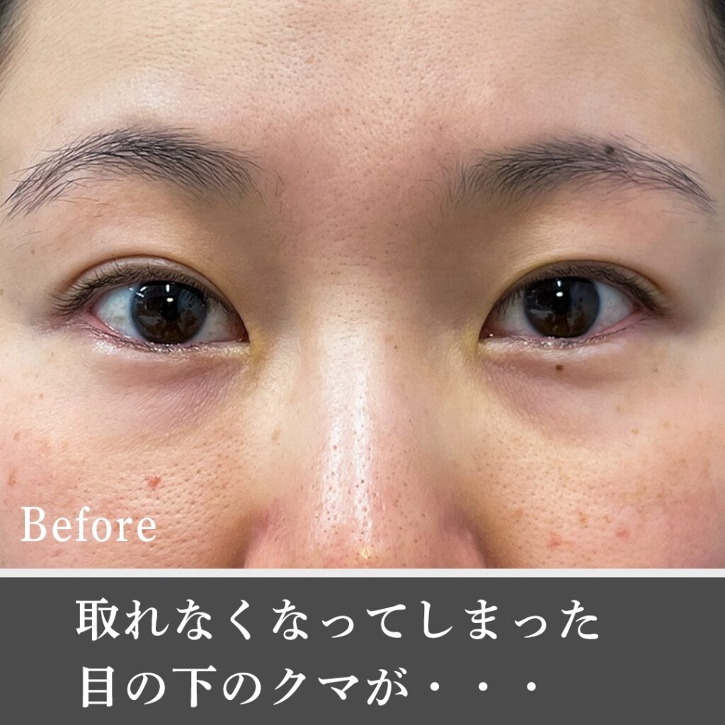 脱脂と脂肪注入でクマを改善した女性の症例写真 (4)