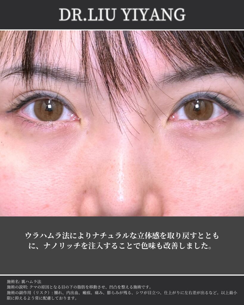裏ハムラ法とナノリッチの症例写真 (32)（広島のクマ取り名医の辻一七子医師が執刀）