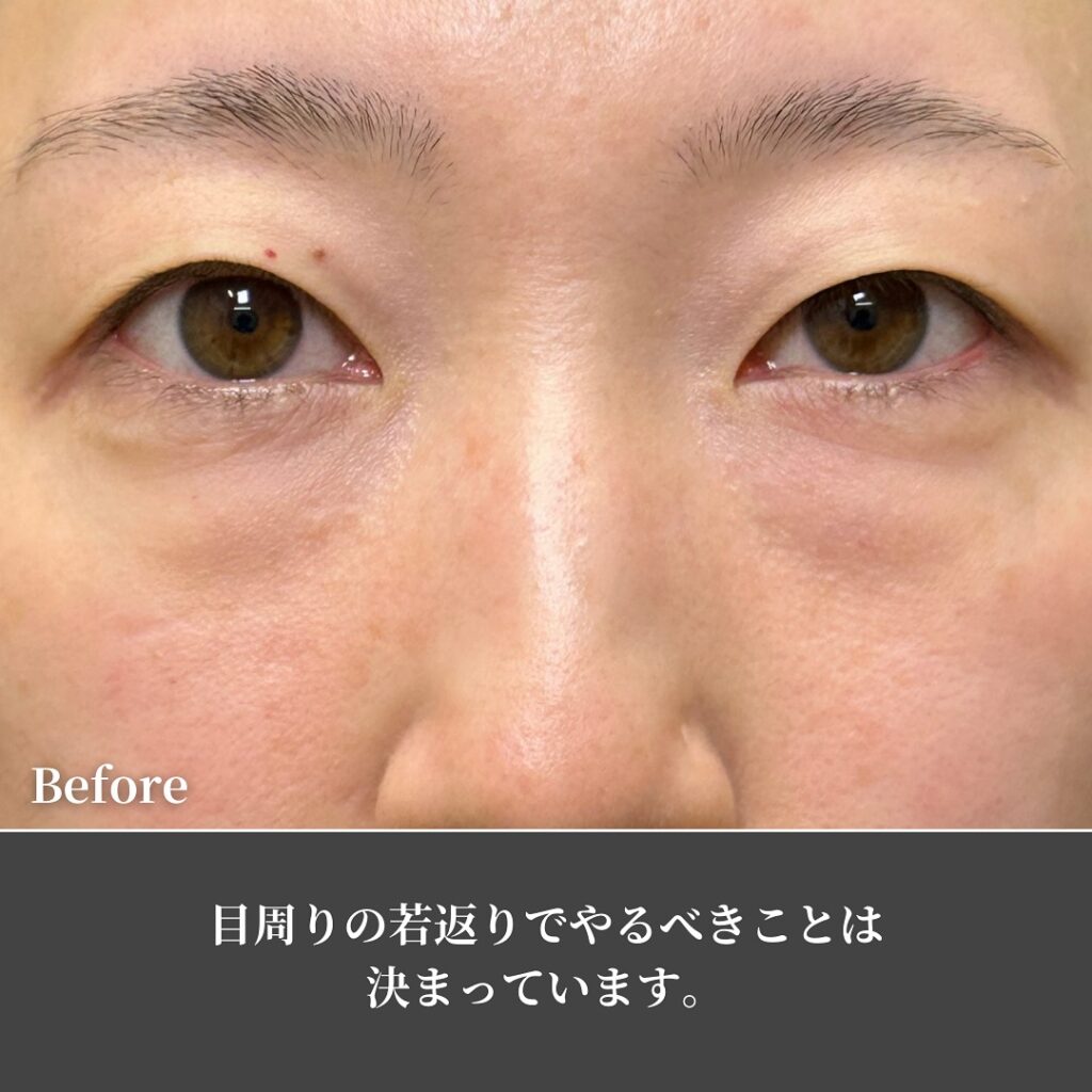 裏ハムラ法と埋没法の症例写真 (4)