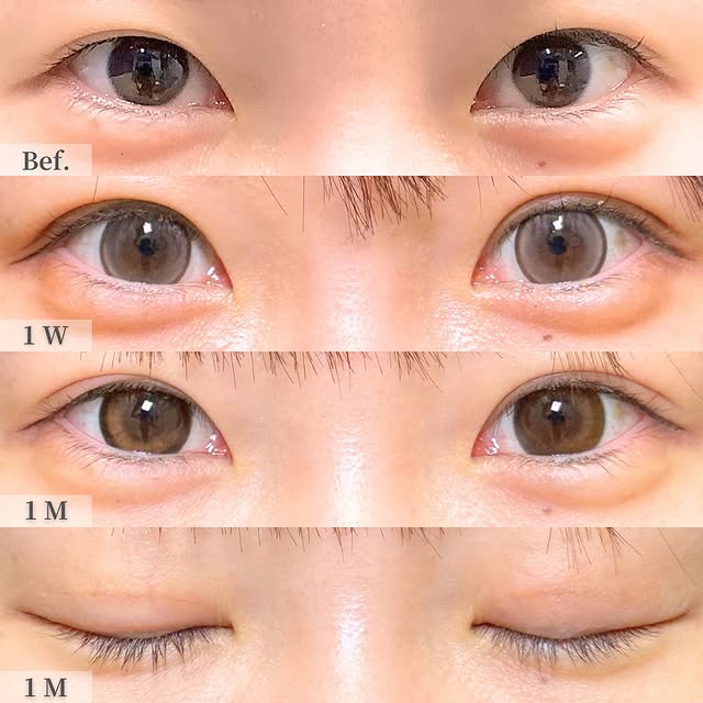 埋没法の症例写真