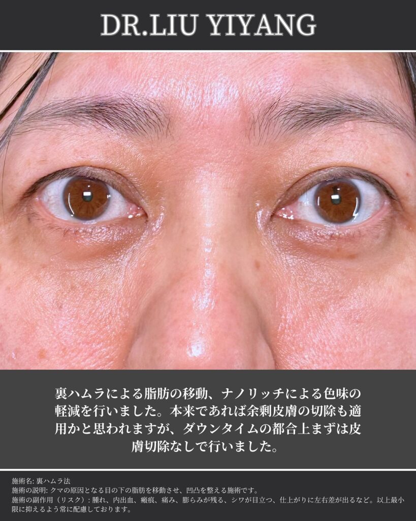 裏ハムラ法とナノリッチの症例 (3)（広島のクマ取り名医の辻一七子医師が執刀）