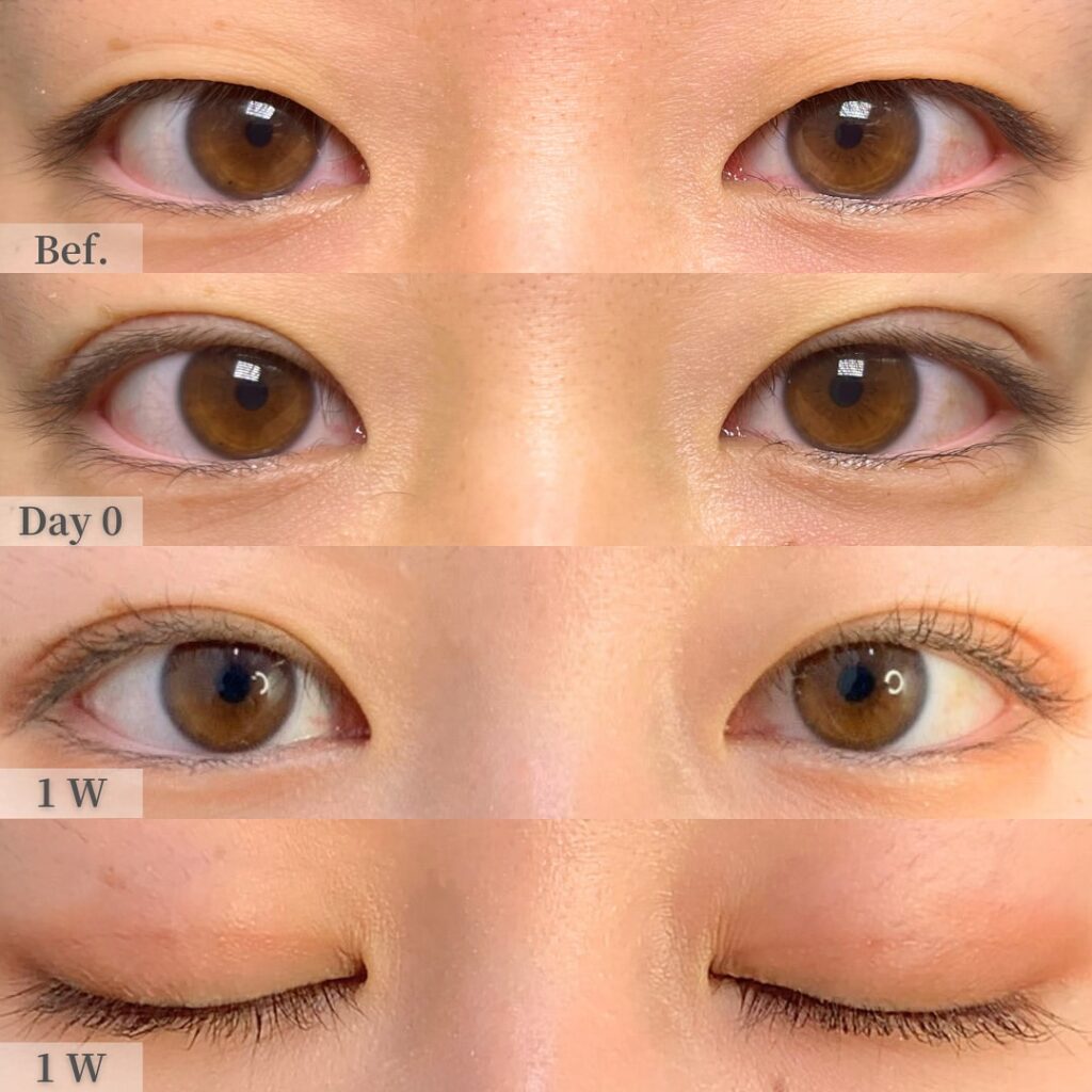 埋没法の症例写真