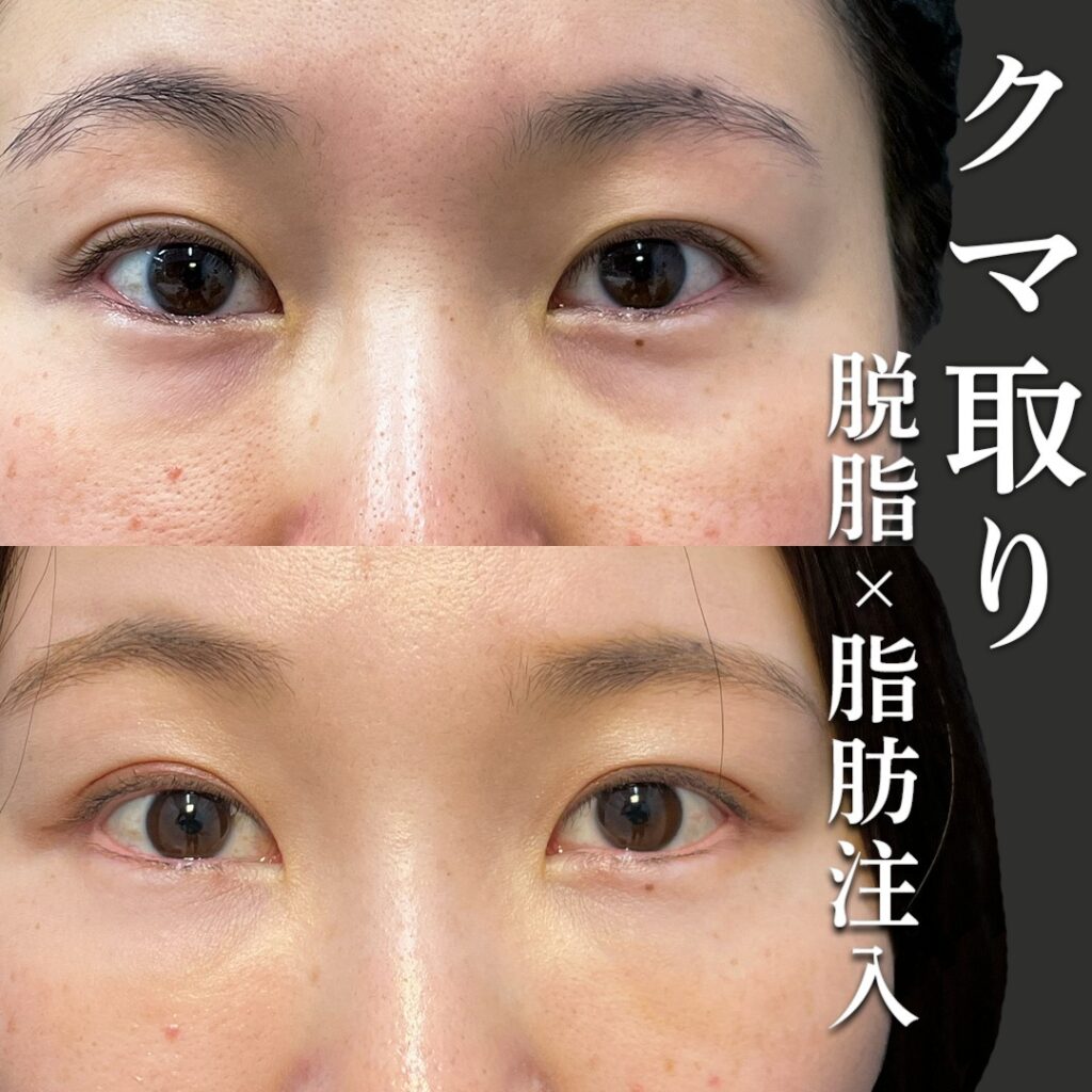 脱脂と脂肪注入でクマを改善した女性の症例写真 (1)