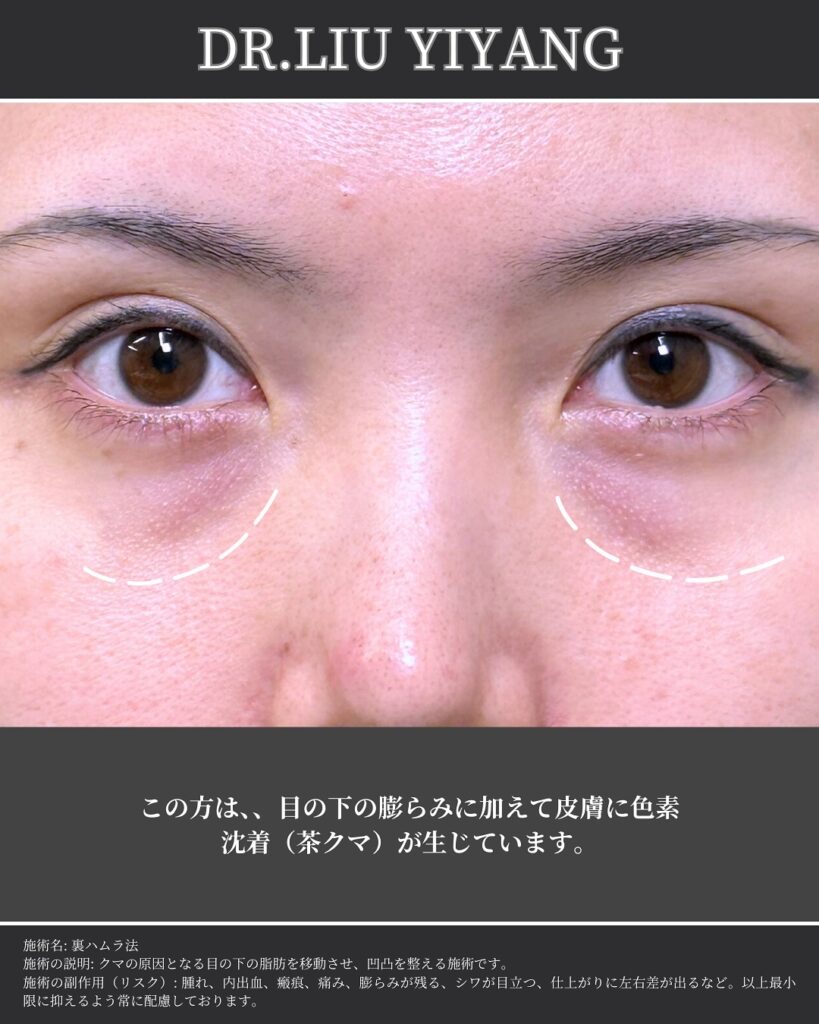 裏ハムラ法とナノリッチの症例写真 (33)（広島のクマ取り名医の辻一七子医師が執刀）