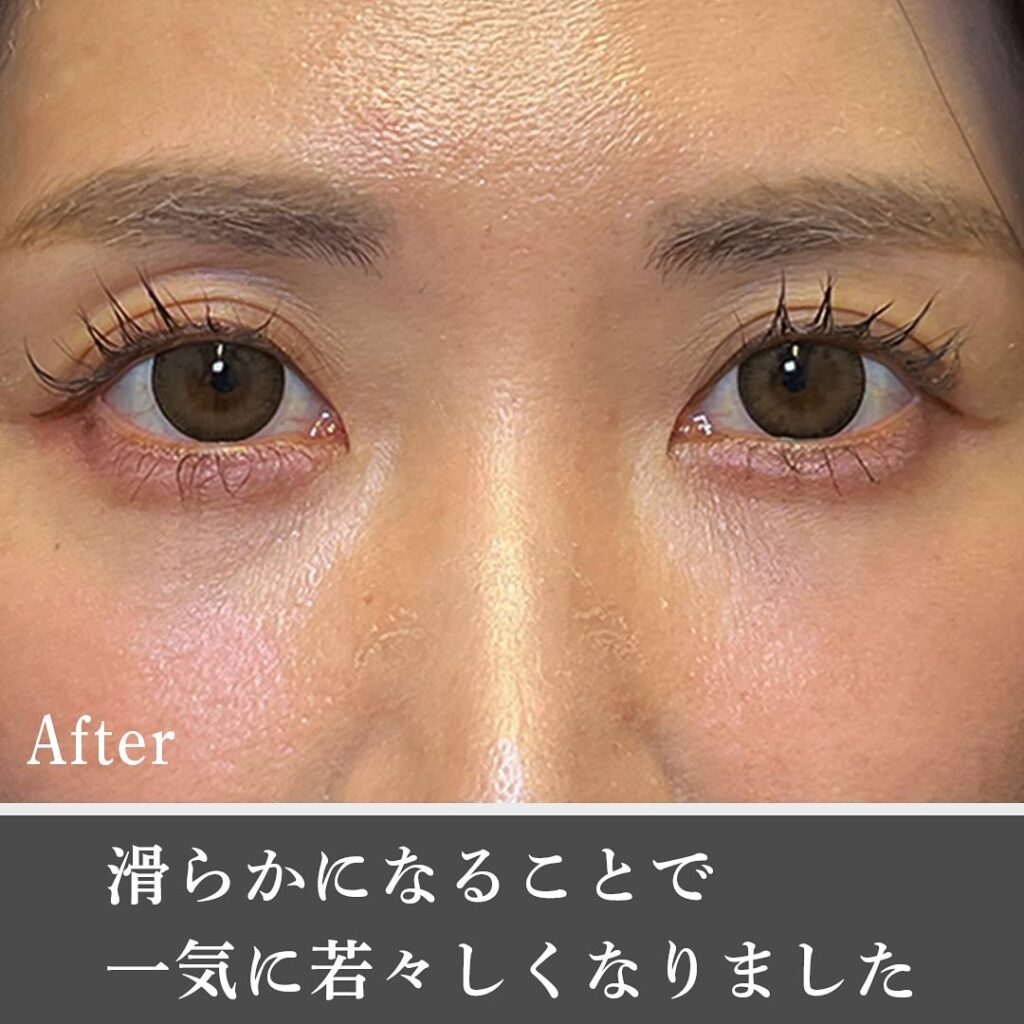 脱脂と脂肪注入の症例写真 (25)