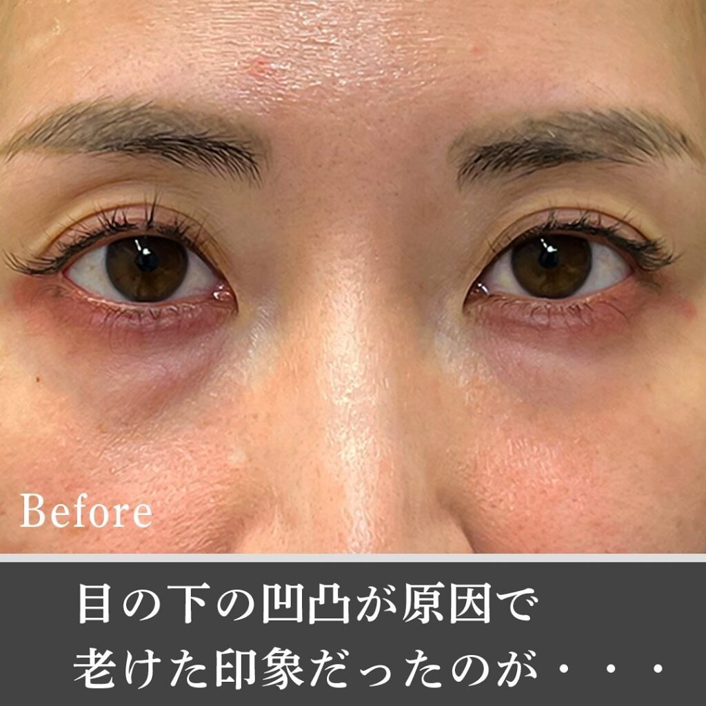 脱脂と脂肪注入の症例写真 (26)