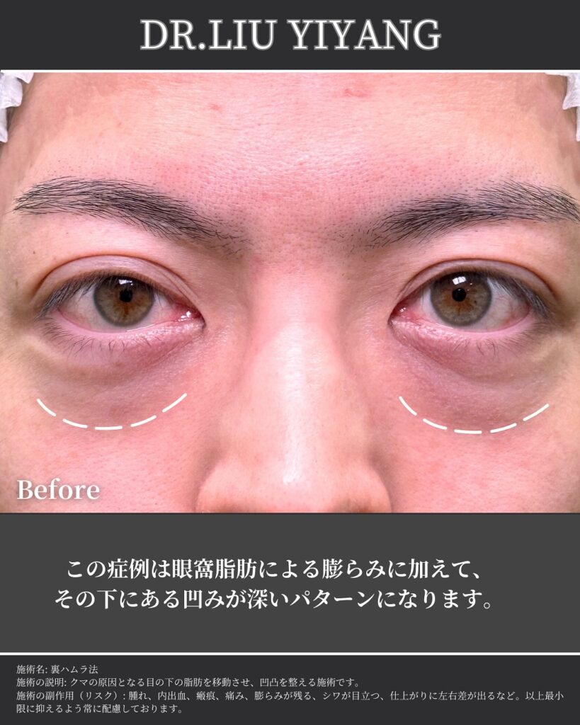 裏ハムラ法とナノリッチの症例写真 (20)（広島のクマ取り名医の辻一七子医師が執刀）