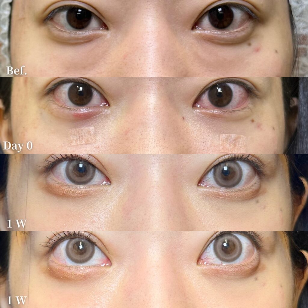 脱脂と脂肪注入の症例 (1)