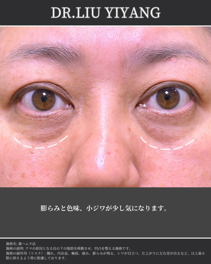 裏ハムラ法とナノリッチの症例 (4)（広島のクマ取り名医の辻一七子医師が執刀）