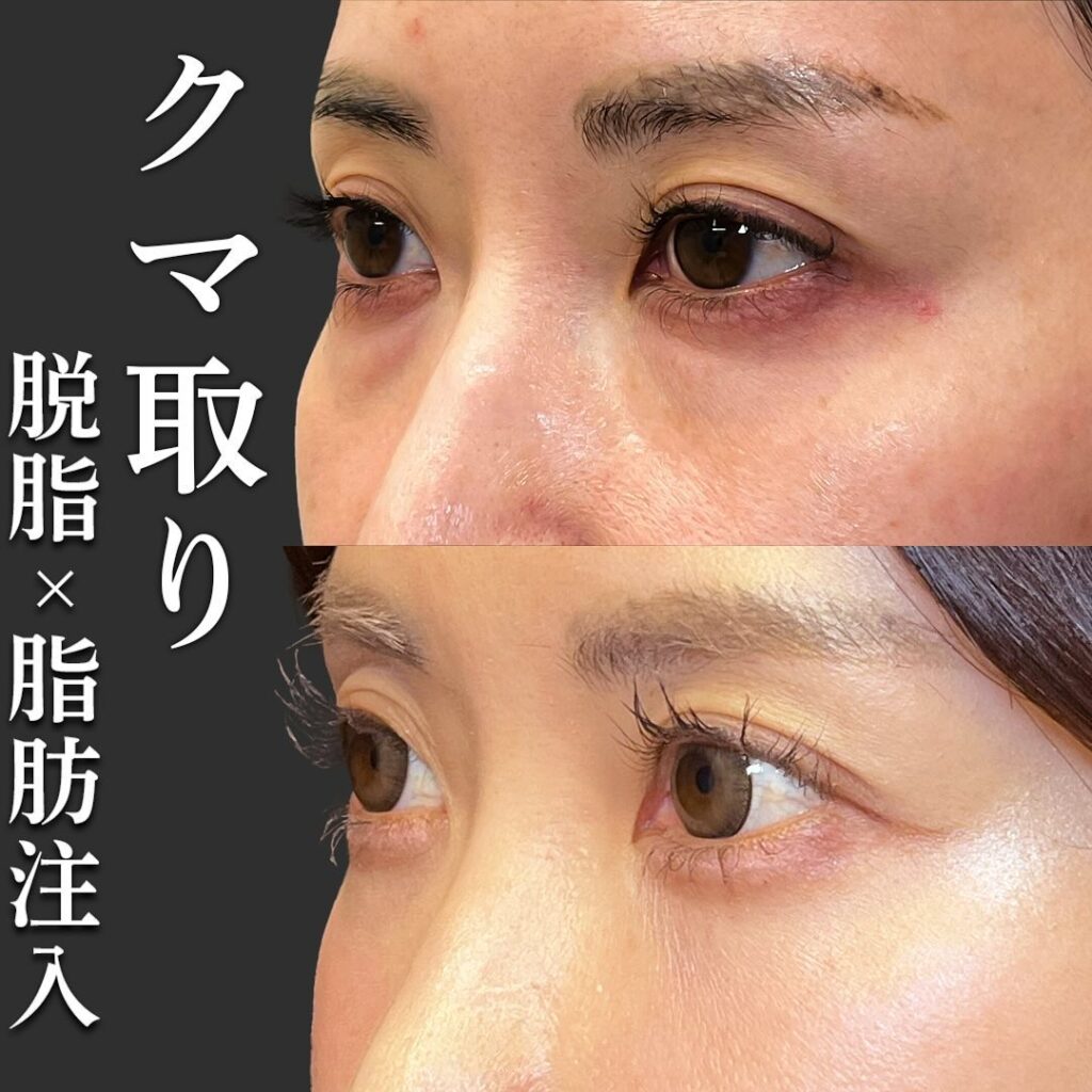 脱脂と脂肪注入の症例写真 (22)