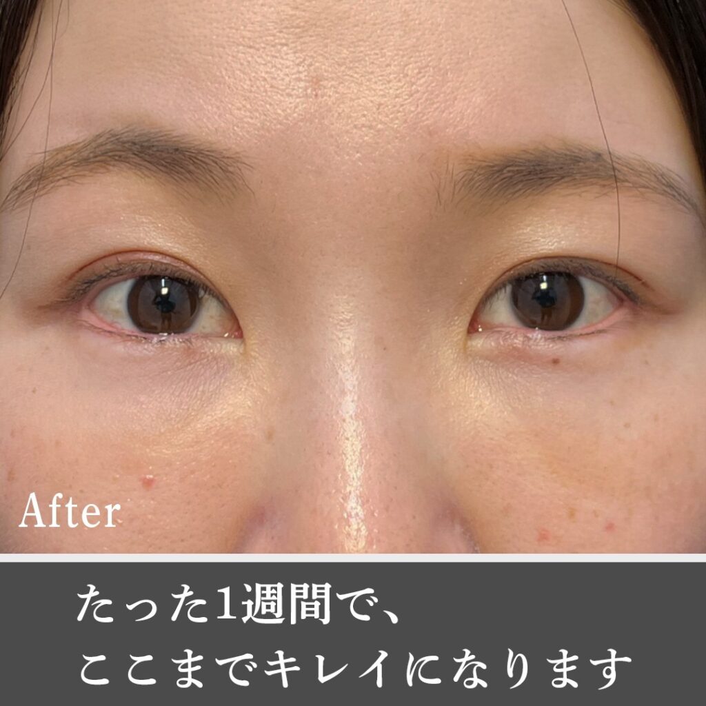 脱脂と脂肪注入でクマを改善した女性の症例写真 (3)