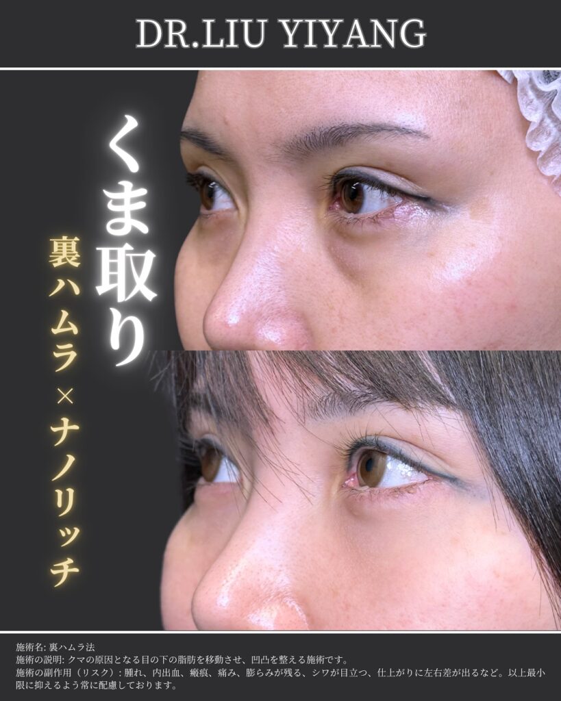 裏ハムラ法とナノリッチの症例写真 (30)（広島のクマ取り名医の辻一七子医師が執刀）