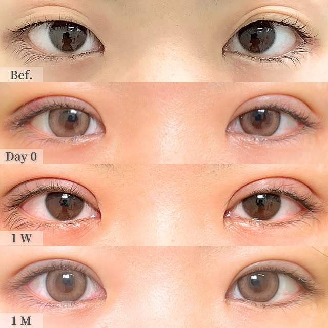 埋没法の症例写真