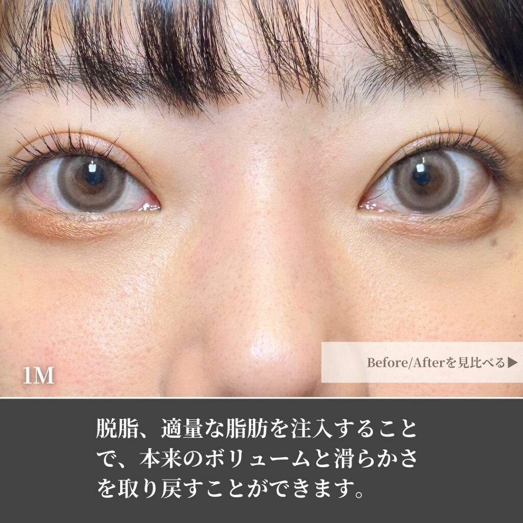 脱脂と脂肪注入の症例 (3)