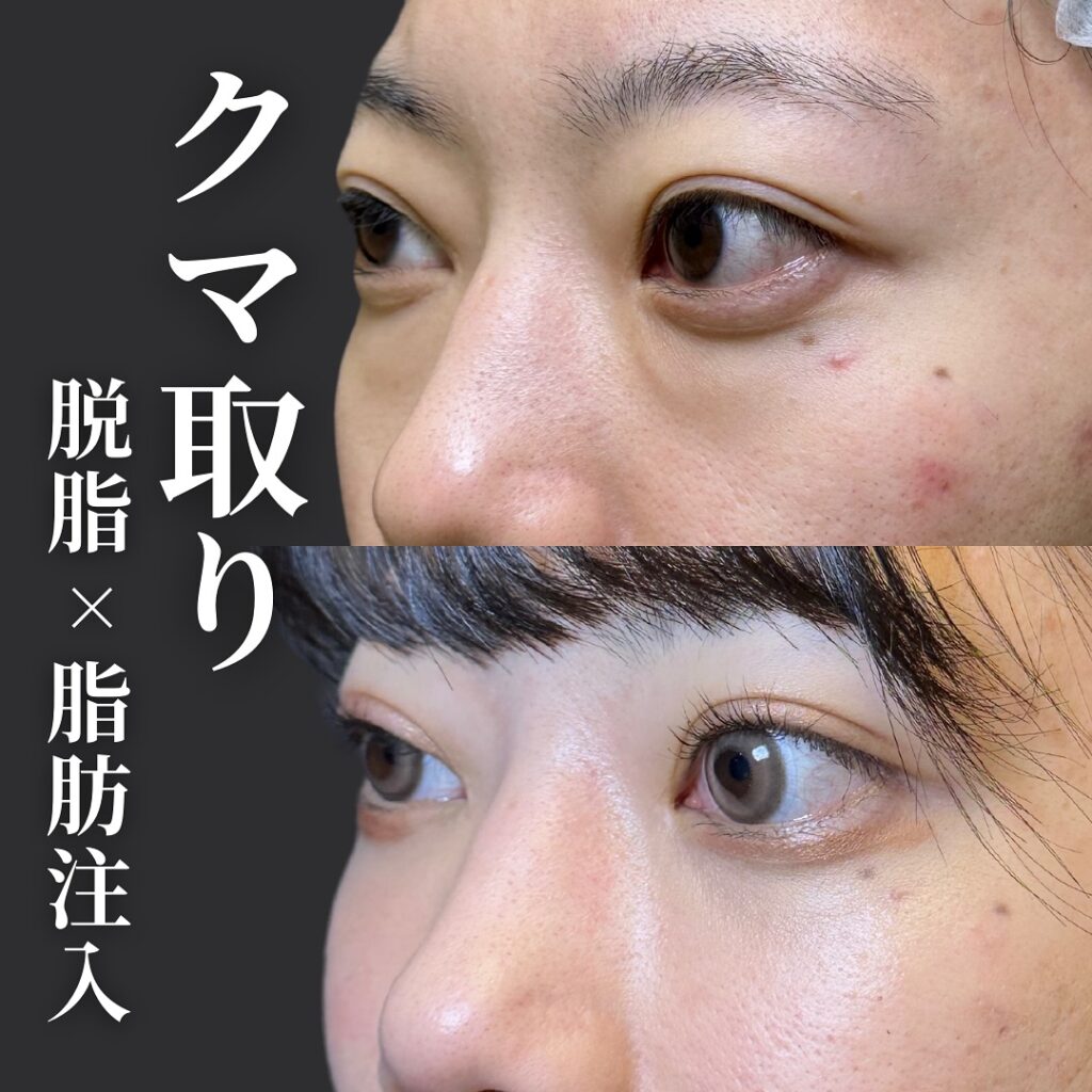 脱脂と脂肪注入の症例 (5)