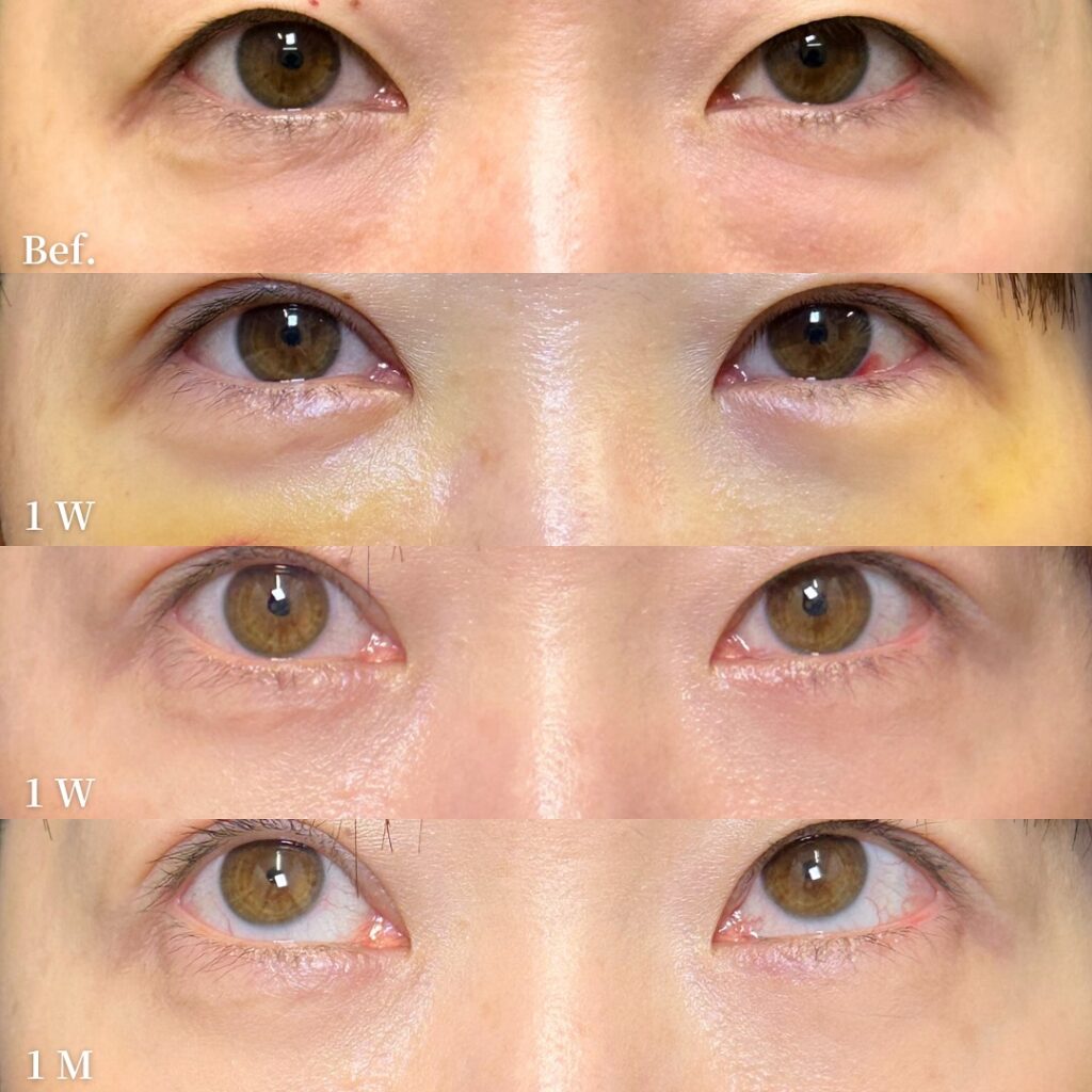 裏ハムラ法と埋没法の症例写真 (1)