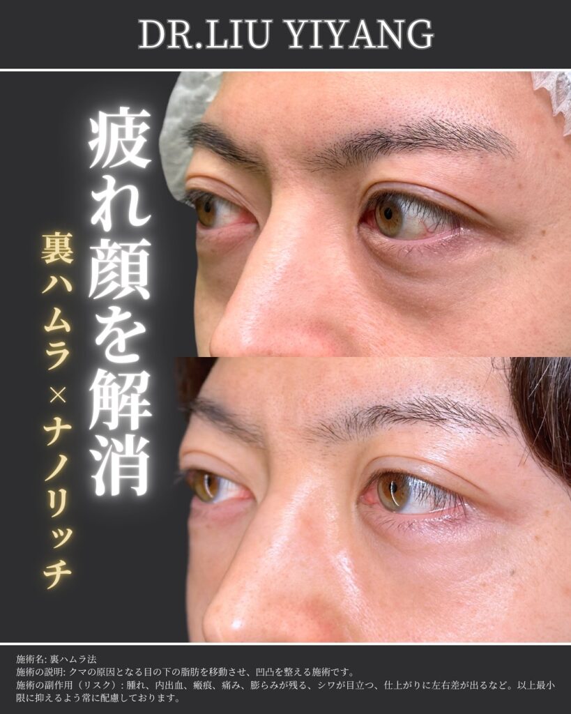 裏ハムラ法とナノリッチの症例写真 (16)（広島のクマ取り名医の辻一七子医師が執刀）