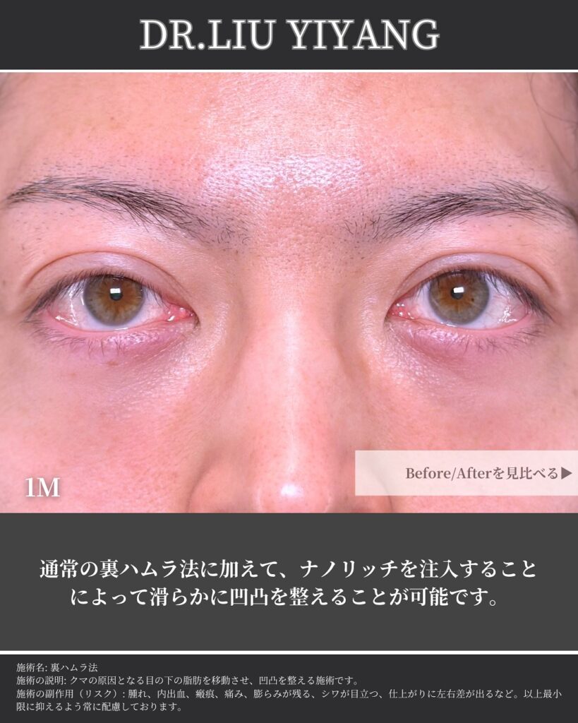 裏ハムラ法とナノリッチの症例写真 (19)（広島のクマ取り名医の辻一七子医師が執刀）